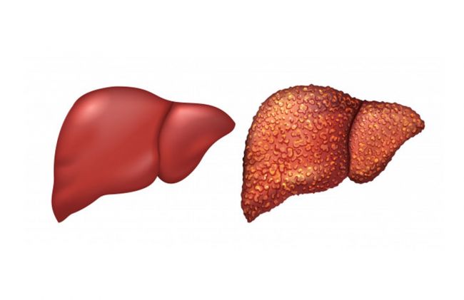 higado-sano-higado-enfermo