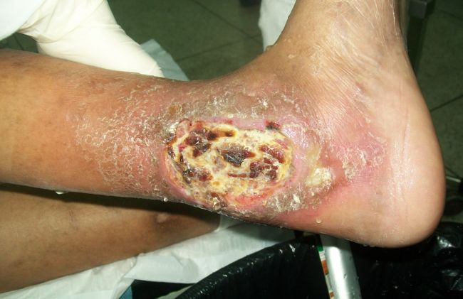 ulcera-pierna