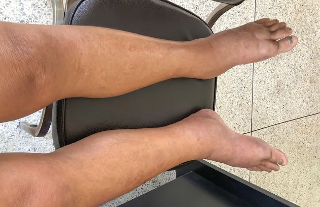 mujer-pierna-hinchada