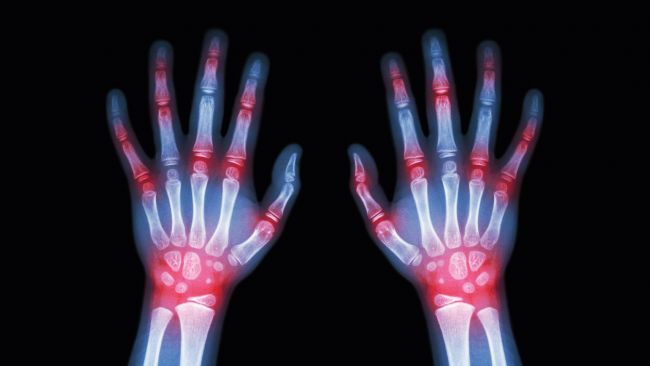 radiografia-artrosis-manos