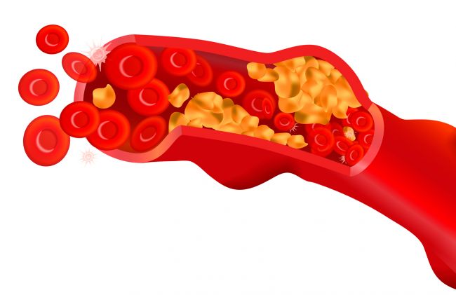 arterias-grasas
