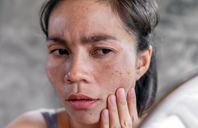 manchas-rostro-mujer