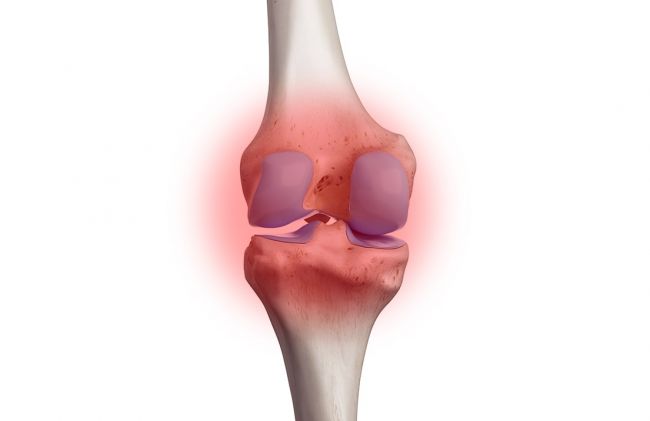 inflamacion-membrana-sinovial