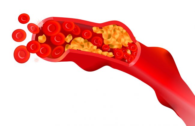 arterias-tapadas