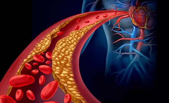 barrido-grasa-arterias