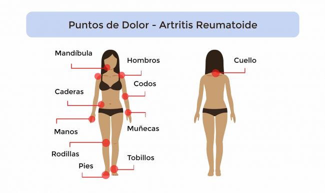 puntos-dolor-artritis
