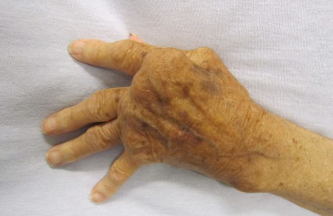 dedos-deformados