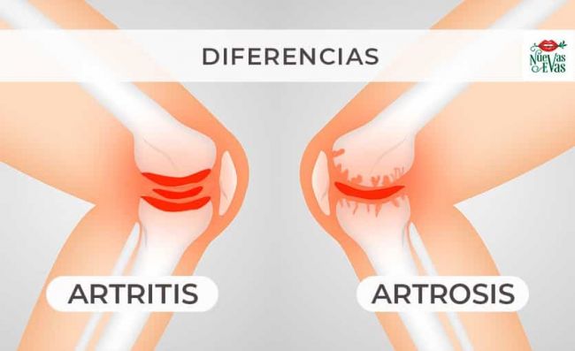 diferencia-entre-artritis-artrosis