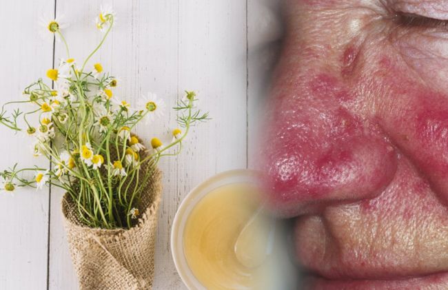 flores-manzanilla-rosacea