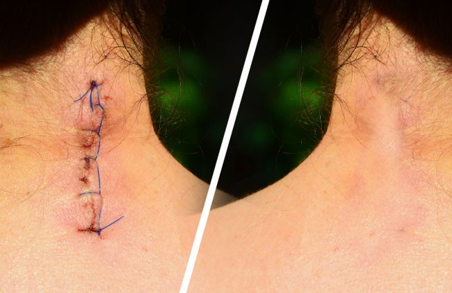 herida-puntos-piel-sin-heridas