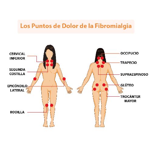 puntos-dolor-fibromialgia