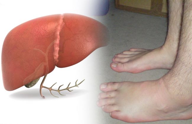 higado-pies-hinchados