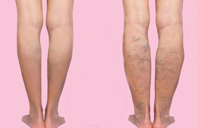 piernas-varices