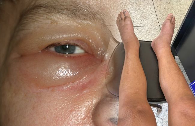 hinchazon-ojos-piernas