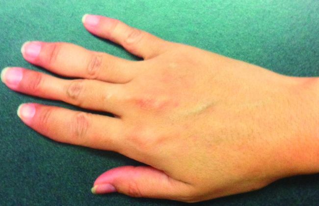 Artritis Psoriásica: Qué es, Causas, Síntomas y Tratamiento | Nuevas Evas