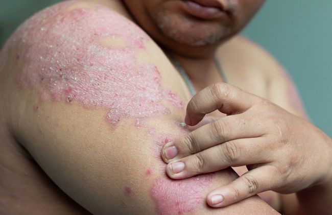 lesion-piel-psoriasis