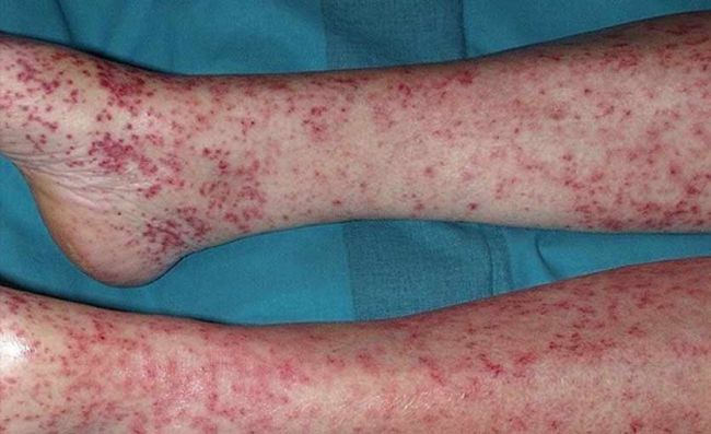 urticaria-piernas