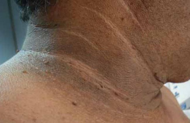 manncha-oscura-cuello