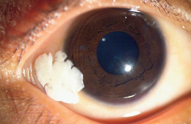 manchas-espumosas-ojo