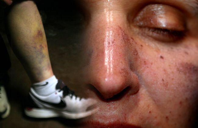 manchas-cara-moreton-pierna