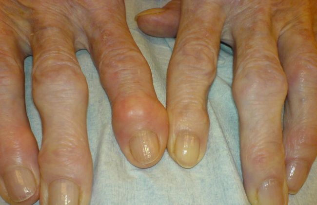 nodulos-heberden-manos