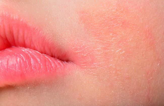mujer-alergia-piel