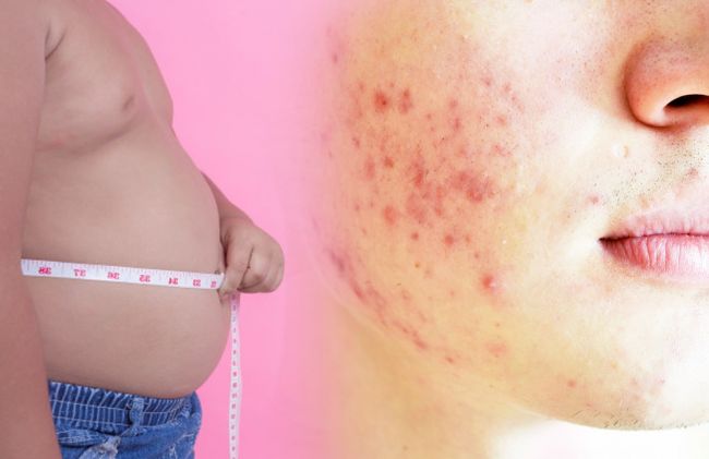 mujer-granos-abdomen-inflado