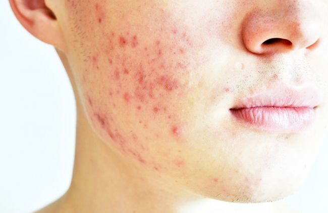 mujer-granitos-rostro