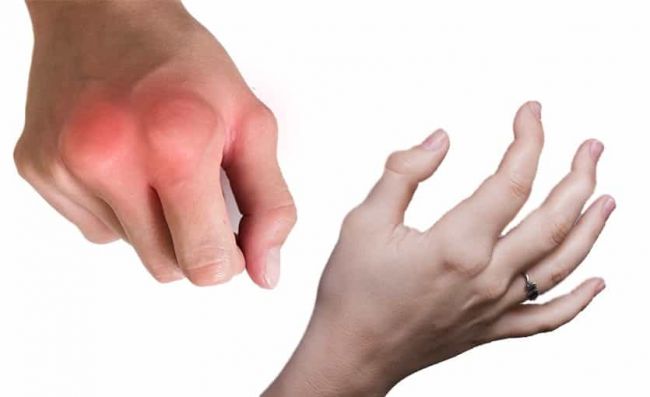 manos-inflamadas-dedos-con-deformidades