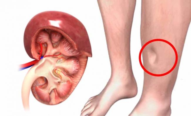 riñon-pierna-hinchada