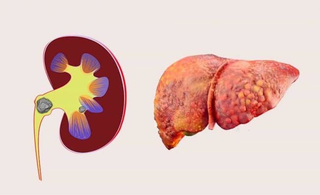 calculos-riñones-higado-graso