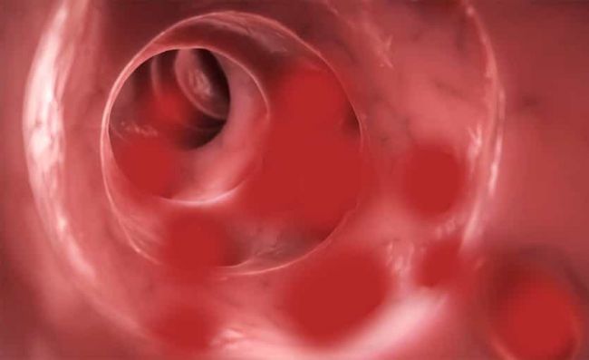 diverticulos-intestino