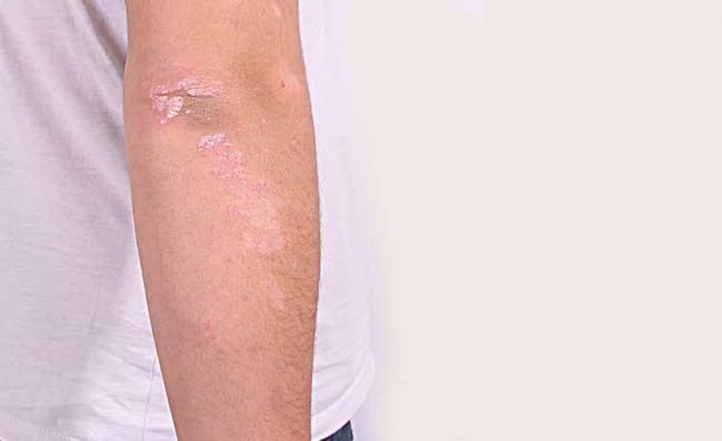 psoriasis-piel-brazo