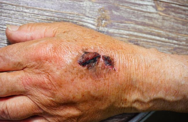 piel-seca-herida-abierta