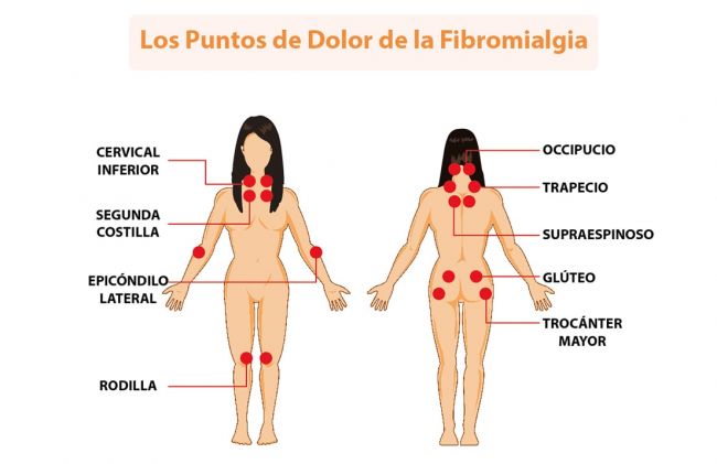 puntos-dolor-fibromialgia