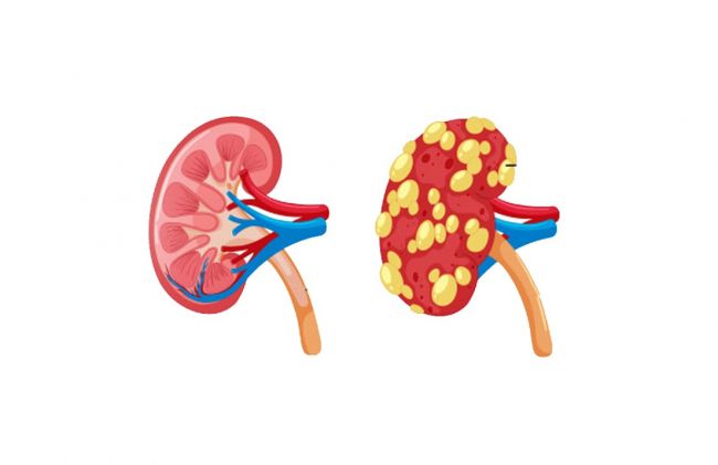 riniones-sano-enfermo