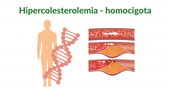 hipercolesterolemia-familiar-homocigota.