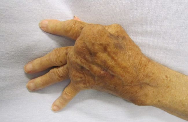 mano-dedos-deformados