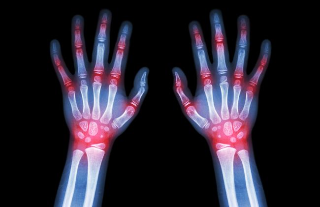 radiografia-manos