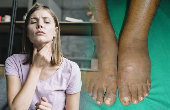 tiroides-pies-hinchados