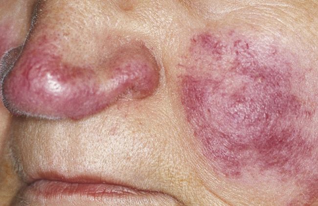 mujer-manchas-cara