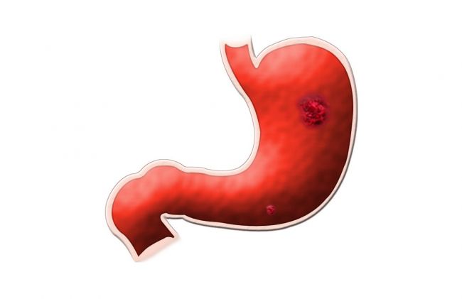 ulcera-estomago