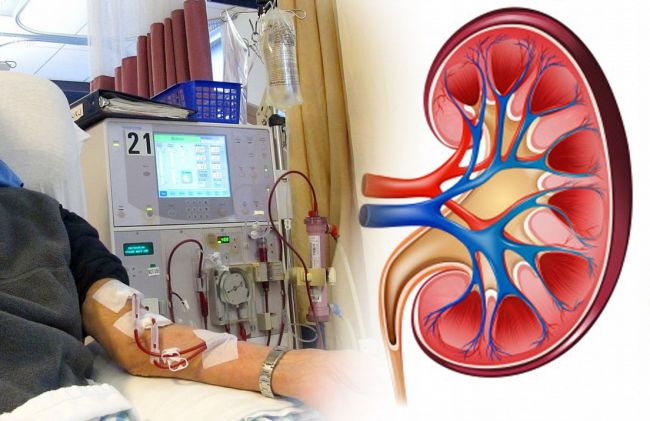 dialisis-rinion