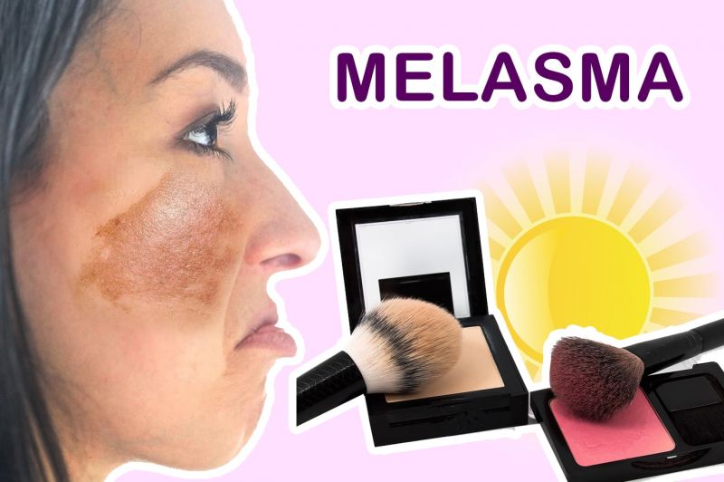 Que es el Melasma, Causas y Tratamiento