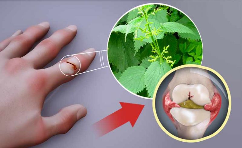 3 Plantas Medicinales para la Artritis