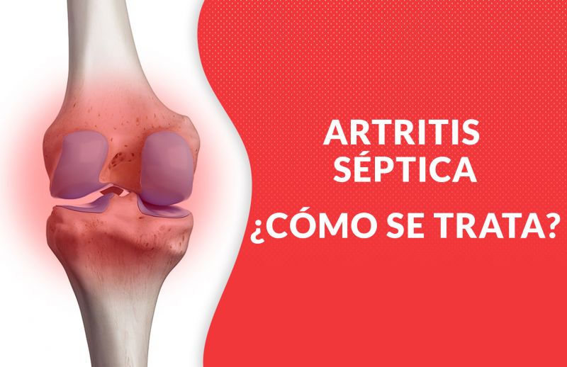 Artritis Séptica: ¿Qué es y cómo se trata?