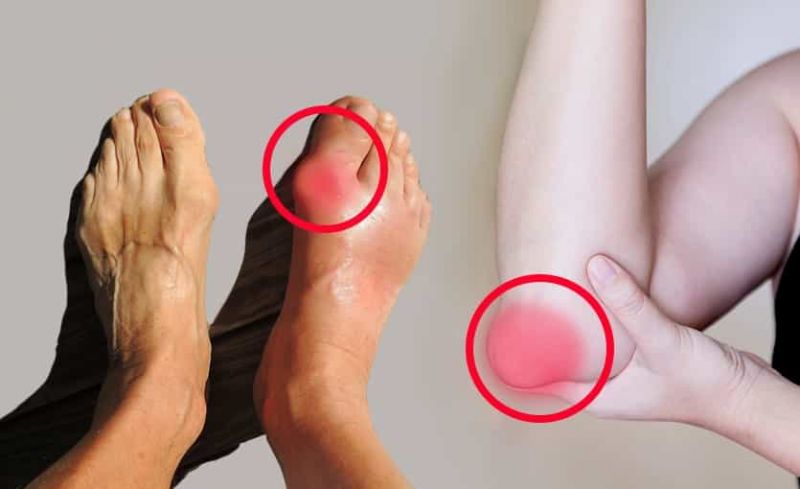 La GOTA: Qué es, Causas, Síntomas, Tratamiento