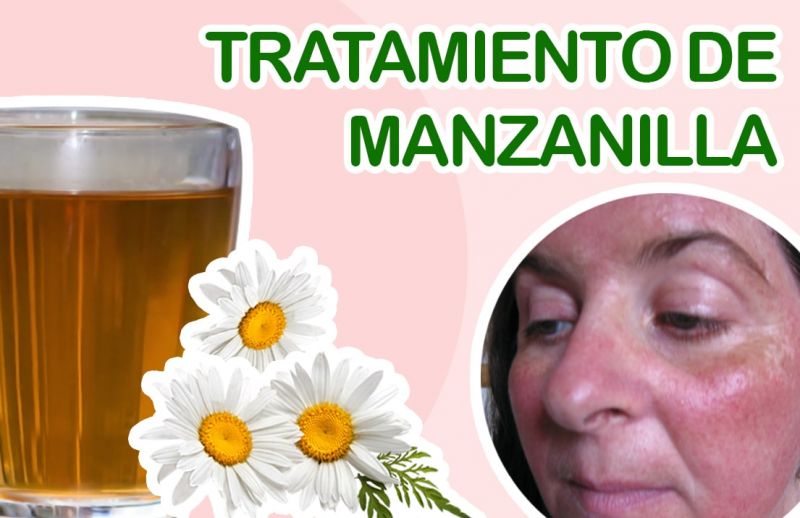 ¿Qué es la Rosácea? Tratamiento de Manzanilla