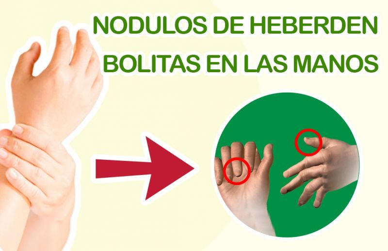 Nódulos de Heberden: Bolitas en las Manos