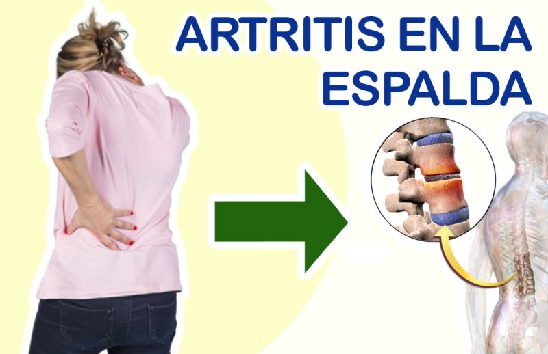 Artritis en la Espalda